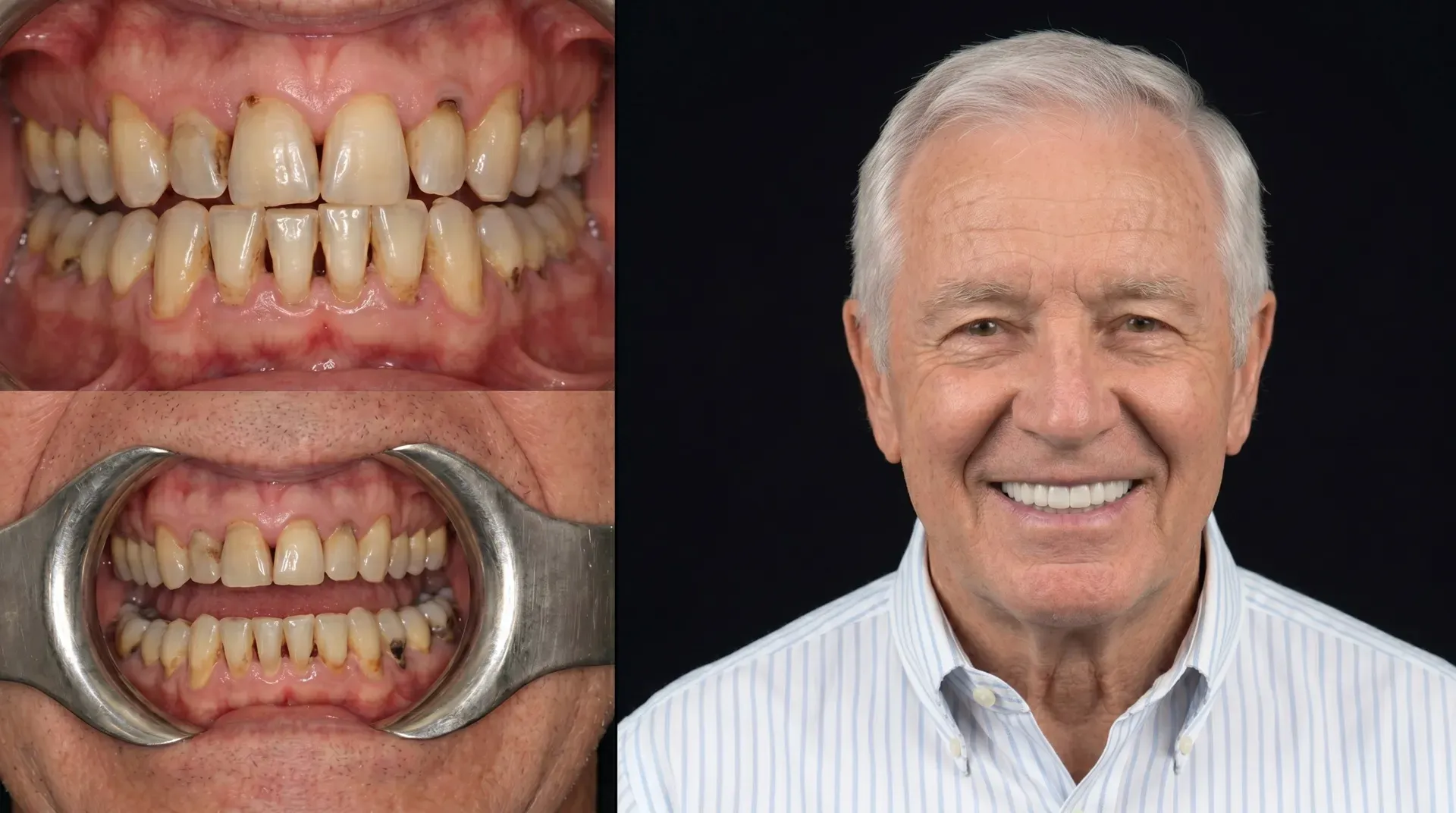 Before and after dental treatment: left shows worn, stained teeth with gum issues; right shows an older man with a full set of white teeth after care.